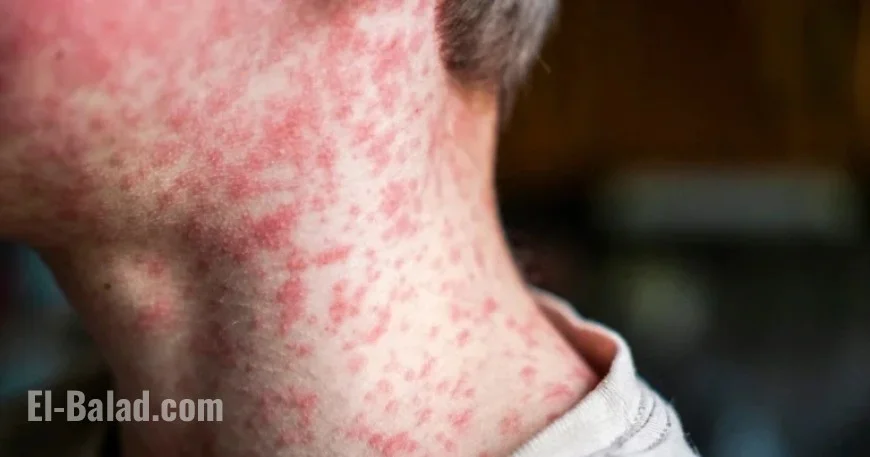 South Carolina Measles Outbreak Escalates, Quarantining Hundreds