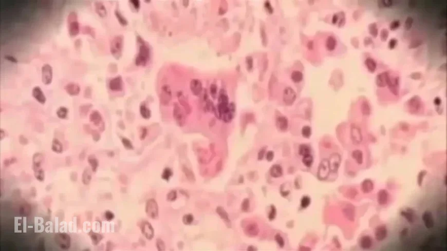 Measles Exposure Alert Issued by New Jersey Health Department at Newark Airport