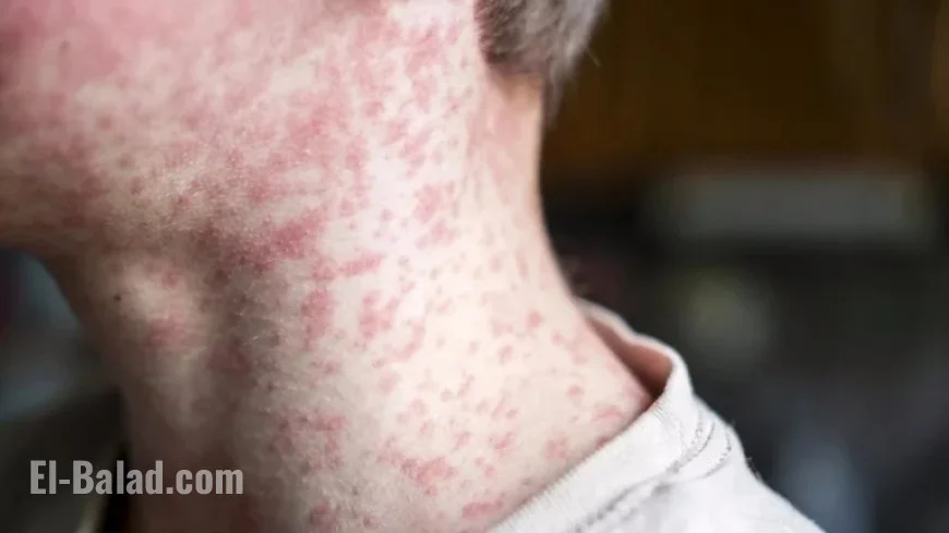 Measles Warning Issued at Major Australian Airport