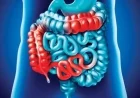 Global Surge of Inflammatory Bowel Diseases Baffles Doctors