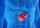 Three Drugs Discovered to Overcome Tumor Resistance in Pancreatic Cancer