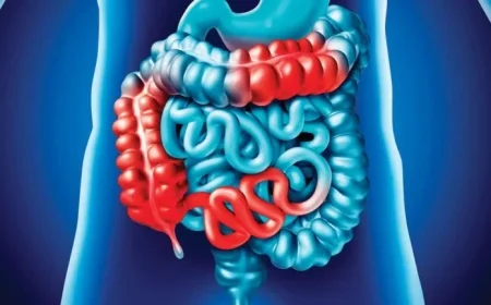 Global Surge of Inflammatory Bowel Diseases Baffles Doctors