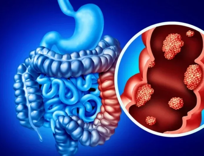 Targeted Immunotherapy Enhances Outcomes in Advanced Metastatic Colorectal Cancer