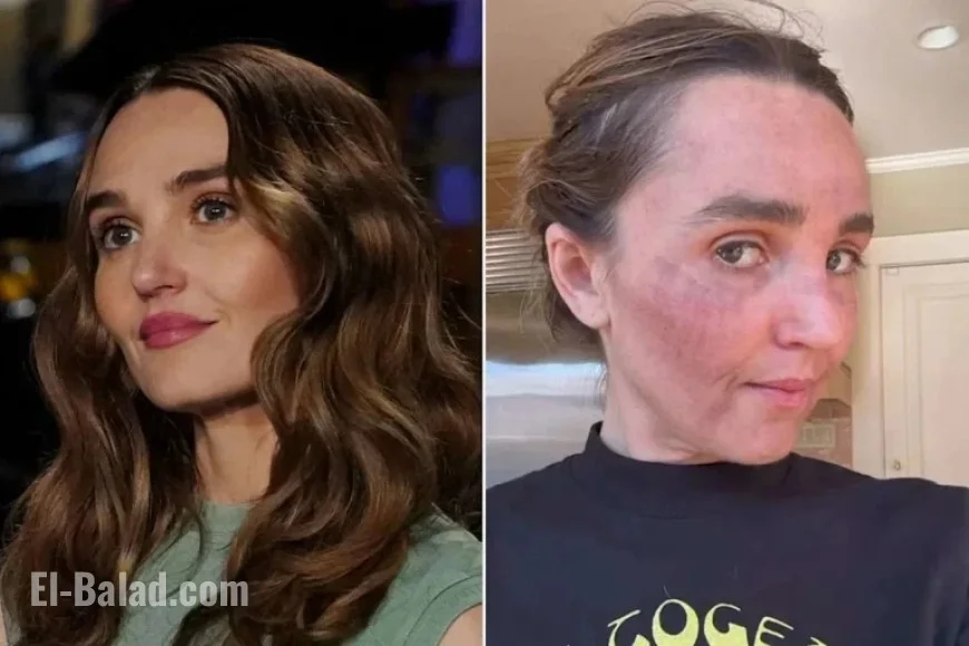 Chloe Fineman Shares Botched Med Spa Procedure Photos on Instagram