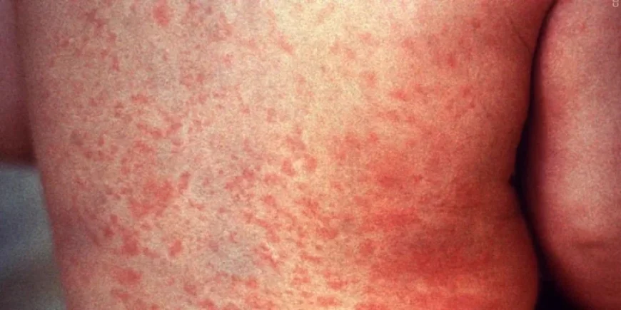 Measles Detected in Federal Detainee in Pinal County, Officials Report