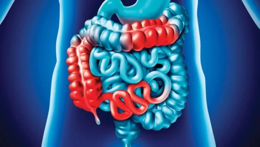 Global Surge of Inflammatory Bowel Diseases Baffles Doctors