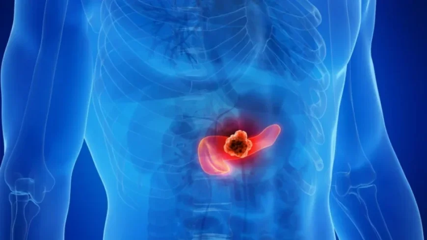 Three Drugs Discovered to Overcome Tumor Resistance in Pancreatic Cancer