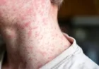 Shasta County Discovers New Measles Exposure Site