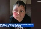 Loyola Medicine Warns: Boy Burned in TikTok Needoh Cube Trend