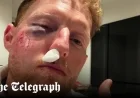 Ben Stokes Injured After Ball Strikes His Face