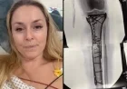 Lindsey Vonn’s Injury: Recovery Timeline and Future Skiing Prospects