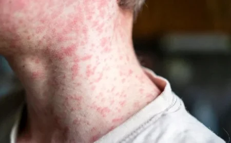 Shasta County Discovers New Measles Exposure Site