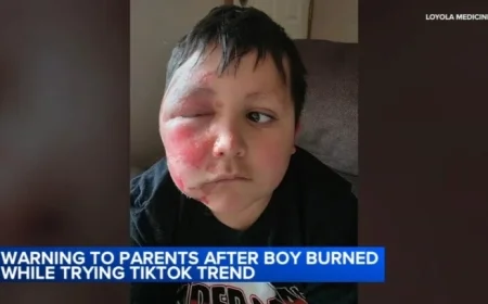 Loyola Medicine Warns: Boy Burned in TikTok Needoh Cube Trend