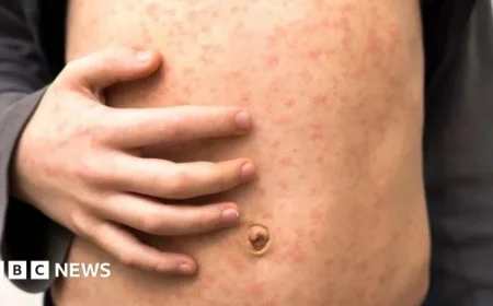 Measles Outbreak Rapidly Spreads Across Multiple London Schools