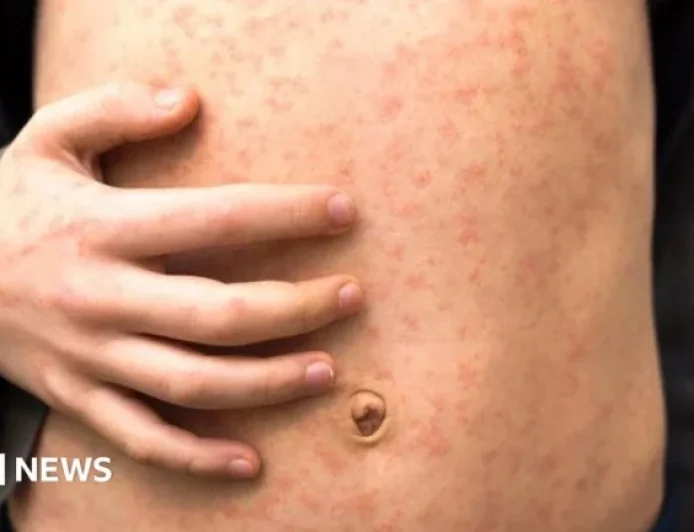 Measles Outbreak Rapidly Spreads Across Multiple London Schools