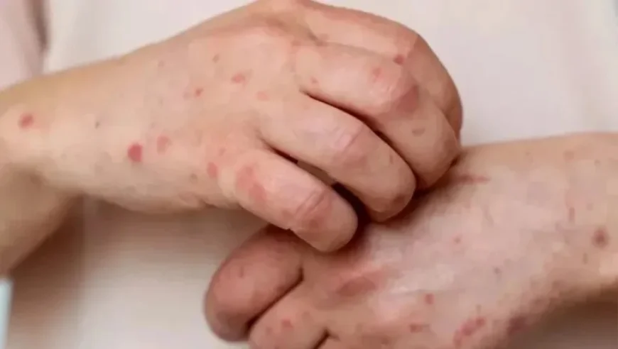 Puebla Ranks Among Top States for Measles Cases in 2026