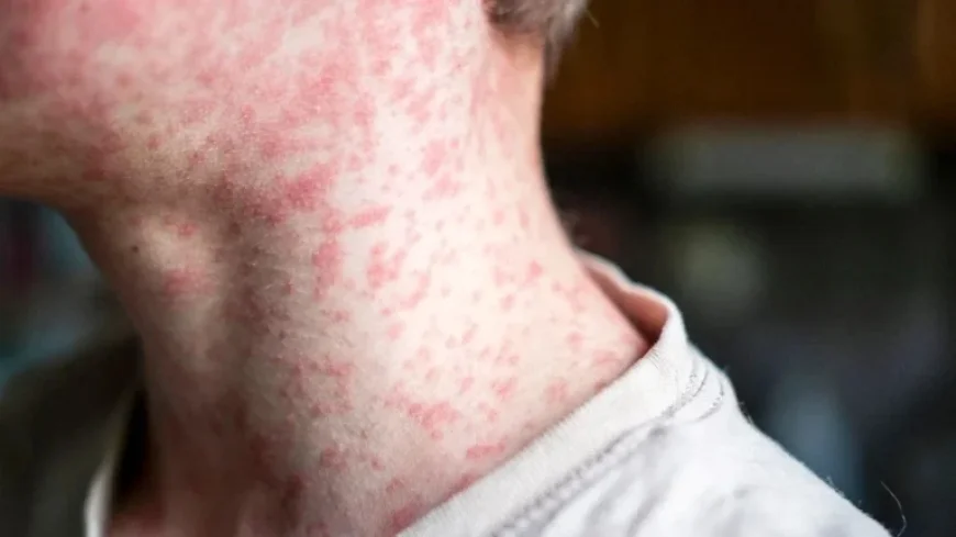 Shasta County Discovers New Measles Exposure Site