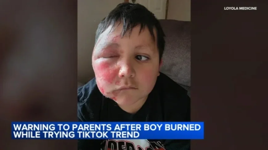 Loyola Medicine Warns: Boy Burned in TikTok Needoh Cube Trend