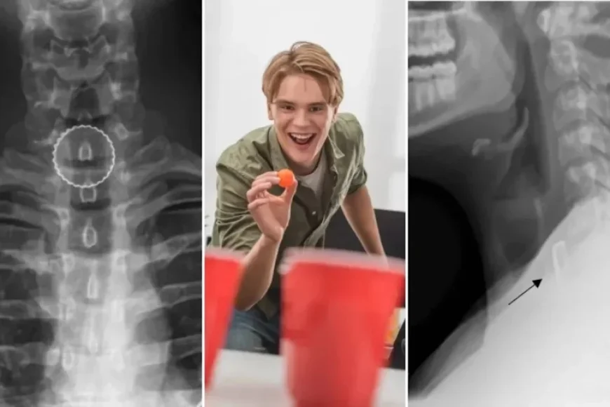 19-Year-Old Undergoes Surgery After Unusual Beer Pong Injury