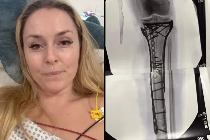 Lindsey Vonn’s Injury: Recovery Timeline and Future Skiing Prospects