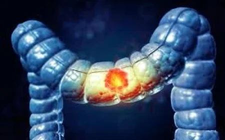 Cancer Colorectal at an Inflection Point as Young Adult Deaths Rise