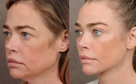 Denise Richards Reveals Dramatic Facelift Results She Initially Feared