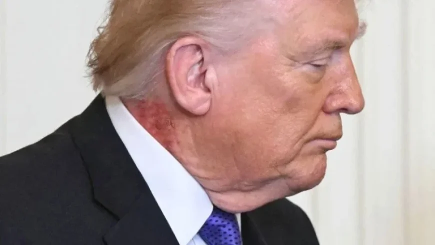 Trump’s Neck Rash Due to Preventative Skin Treatment, Doctor Reveals