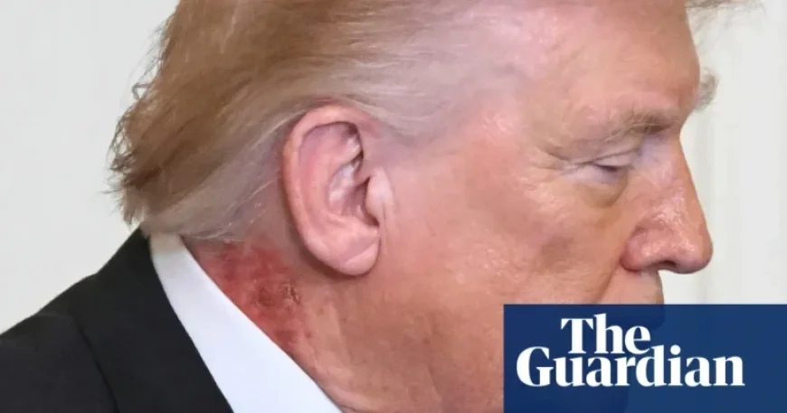 White House: Trump’s Neck Rash Results from Preventative Skin Treatment