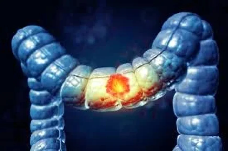 Cancer Colorectal at an Inflection Point as Young Adult Deaths Rise