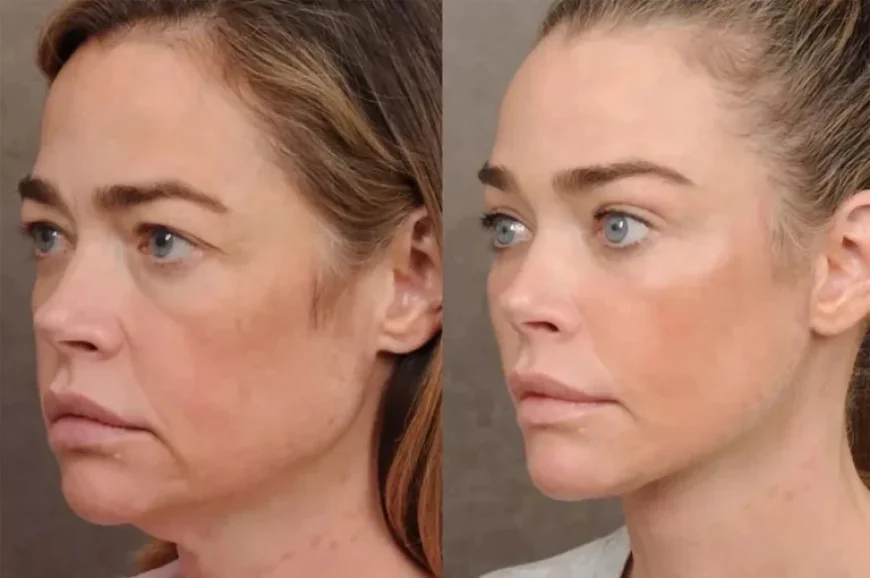 Denise Richards Reveals Dramatic Facelift Results She Initially Feared