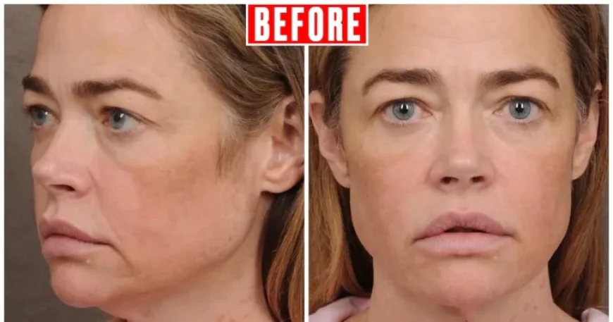 Denise Richards Reveals Stunning Facelift Transformation in Before and After Photos