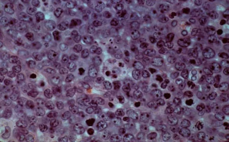 Allogene’s CAR-T Therapy May Prevent or Delay Cancer Return