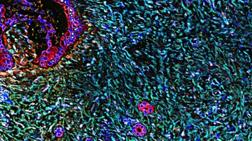 Expert Evaluates Promising Breakthrough in Pancreatic Cancer Treatment