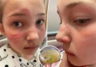 Charlotte Warns After Squishy Toy Burns 10-Year-Old Bella