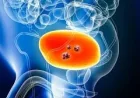 SMC Backs Metastatic Cancer Drug Pair for 200 Scots