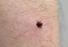 Montreal Warns on 161 Lyme Disease Cases in 2025
