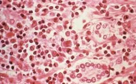 WHO Details Seven Hantavirus Cases on MV Hondius — Hantavirus Infections Cruise Ship