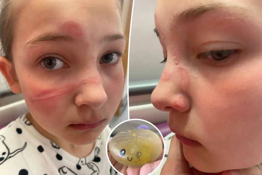Charlotte Warns After Squishy Toy Burns 10-Year-Old Bella