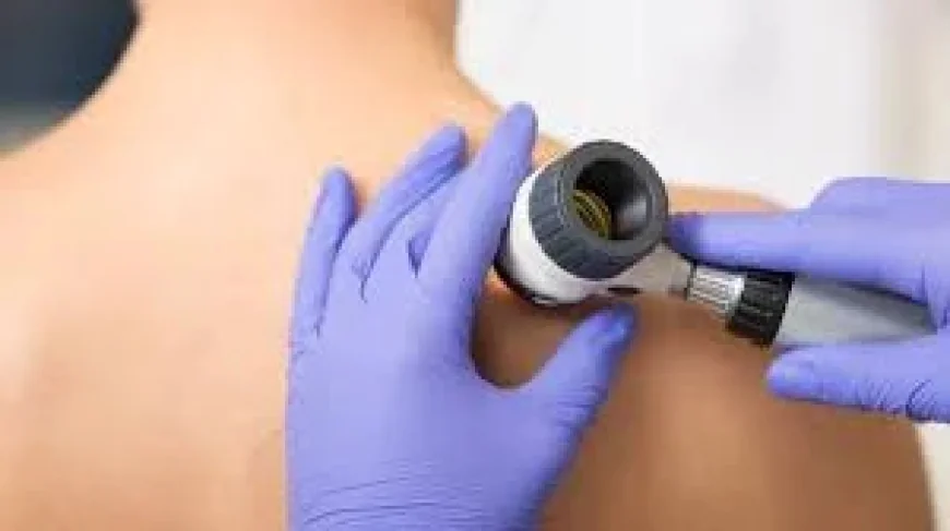 Cancer Research UK raises Melanoma warning after 20,980 UK diagnoses