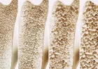 Researchers Find Little Benefit From Calcium in 69-Trial Review