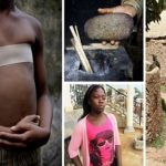 3.8 مليون فتاة يتعرضن لـ«كي الثدي» لحمايتهن من الاغتصاب